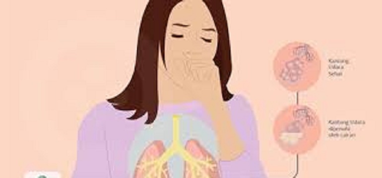Pneumonia Lebih Mematikan Muncul di Asia Tengah